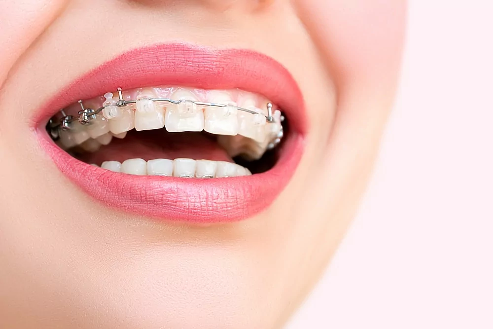 Self-Ligating Braces