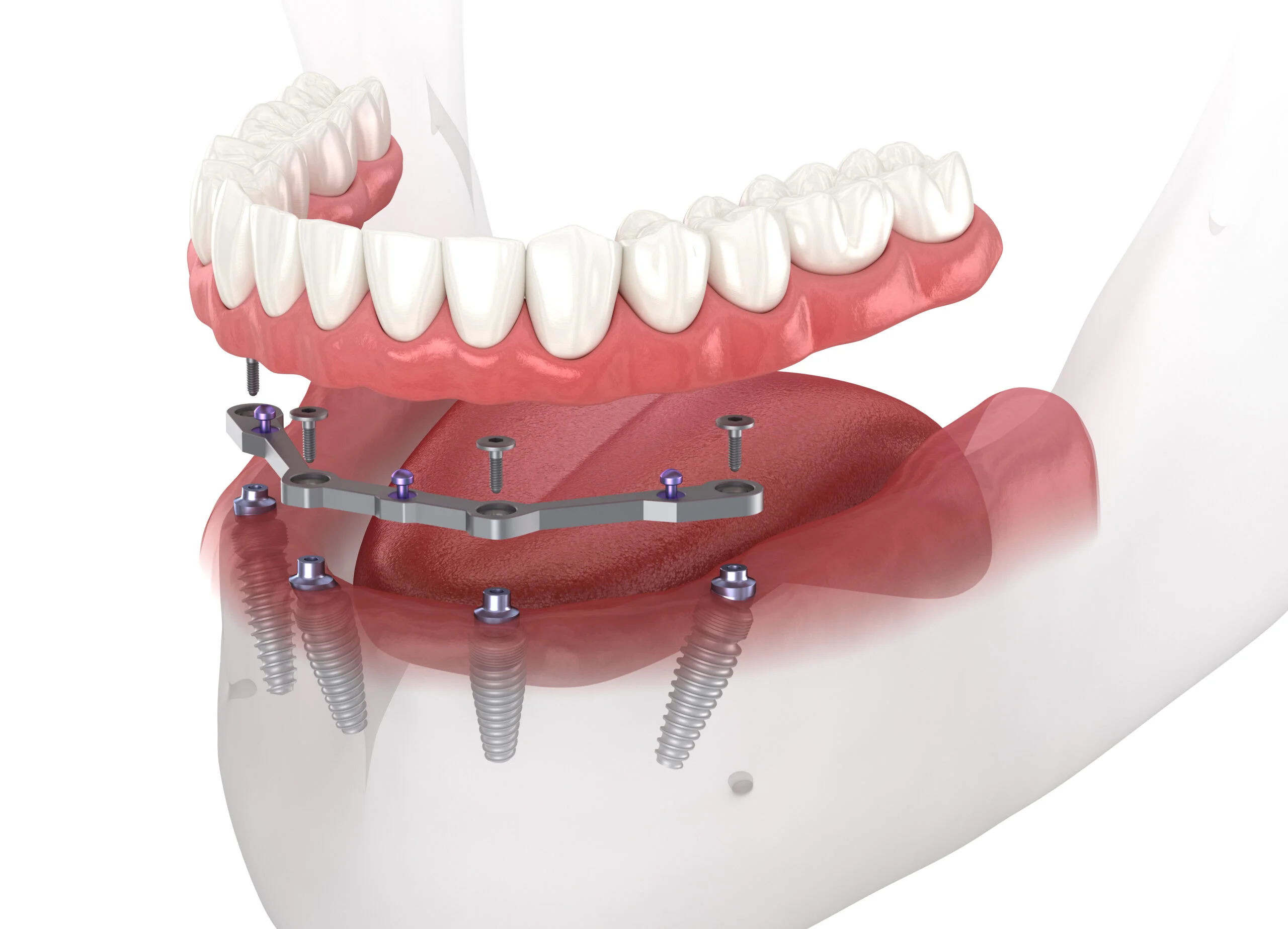 Implant Supported Dentures
