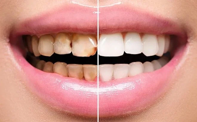 Full Mouth Restoration