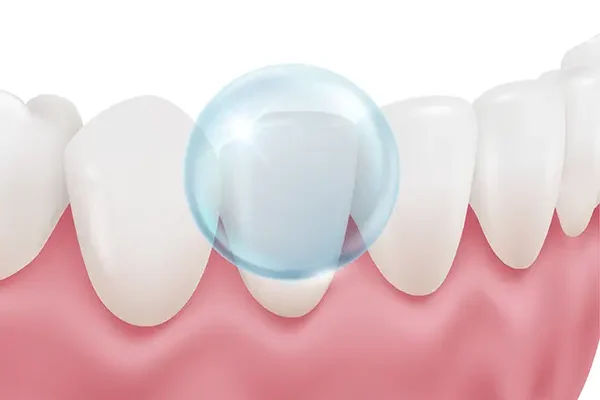 fluoride-treatment-2